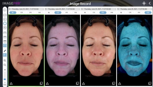 ImagePro Image Record screen showing normal, polarized, and UV facial scans side by side